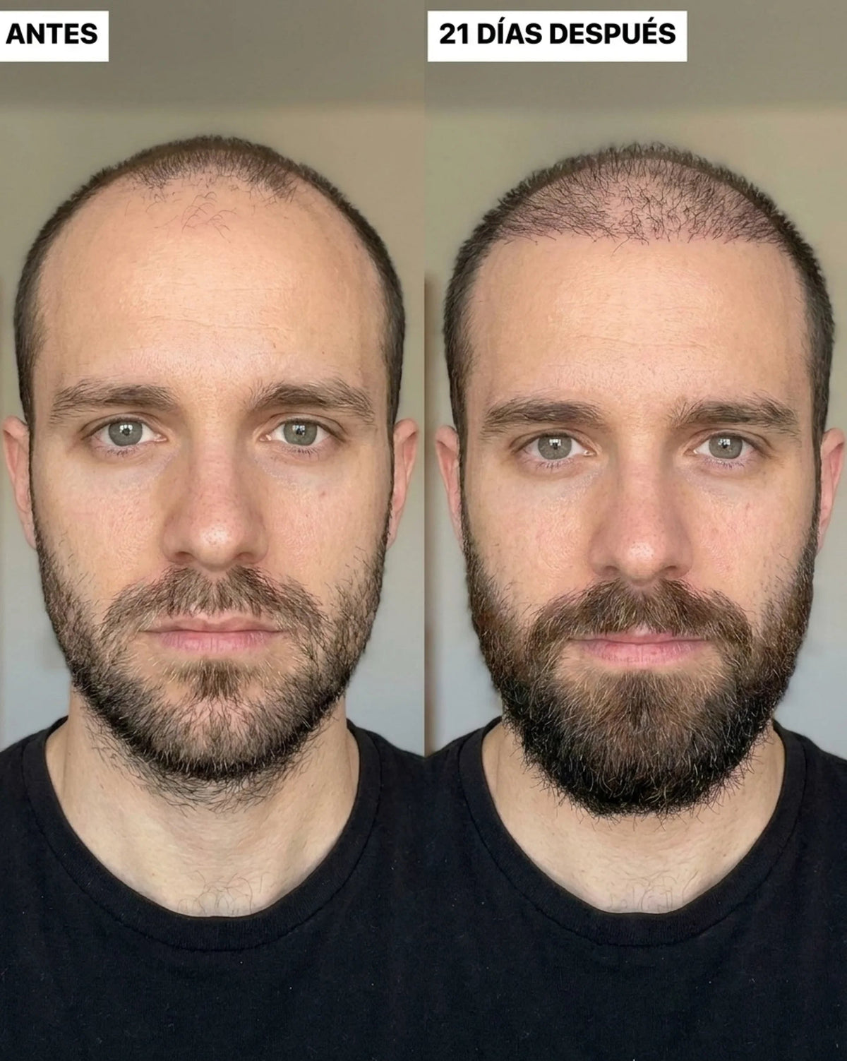 Starter Kit de Cabello y Barba